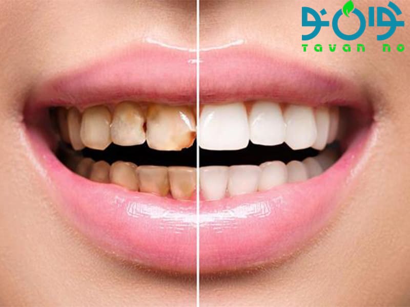 لمینت دندان چیست و چه مراحلی دارد؟ + عوارض لمینت دندان
